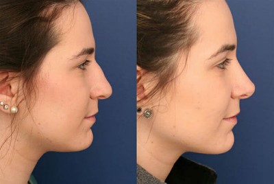 What Is Cosmetic Nose Surgery?