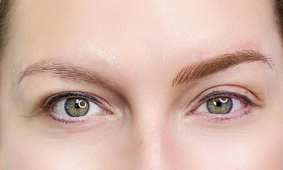 میکروپیگمنتیشن و فرق آن با فیبروز و میکروبلیدینگ