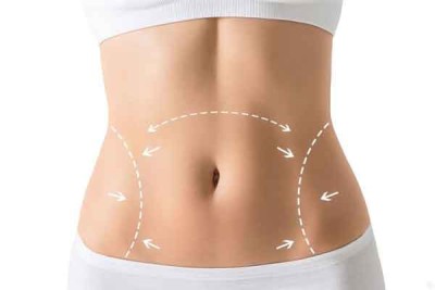 ابدومینوپلاستی