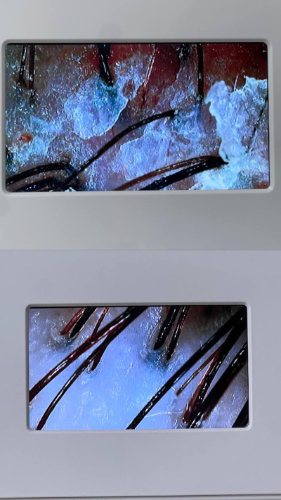 پاکسازی اسکالپ سر